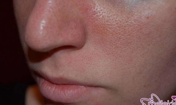 Cilt Deliklerine Ne İyi Gelir Öneriler Bizden