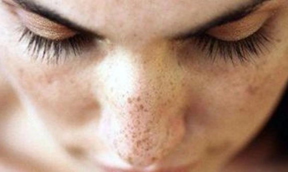 Hamilelikten Kalma Lekelerden Müzdarip misiniz?