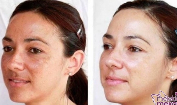 Hamilelikten Kalma Lekelerden Müzdarip misiniz?