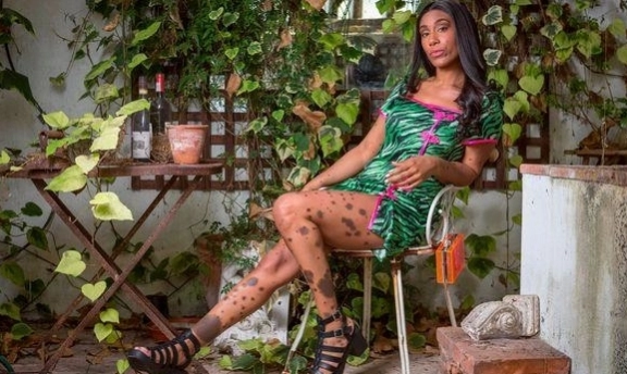 Dalmaçyalı Kadın Cheryl Shaw'ın Hayat Hikayesi